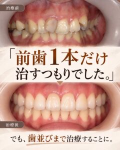 前歯の変色を治したい。矯正とセラミックを選んだ理由