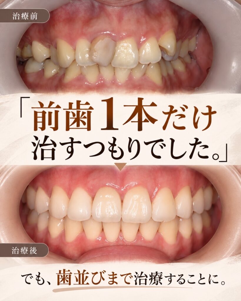 前歯の変色を治したい。矯正とセラミックを選んだ理由