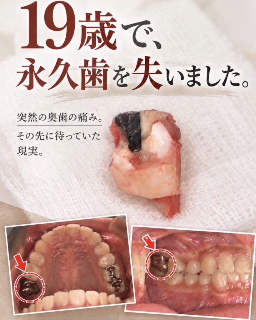 19歳で永久歯を失った私の治療体験｜部分矯正とインプラント